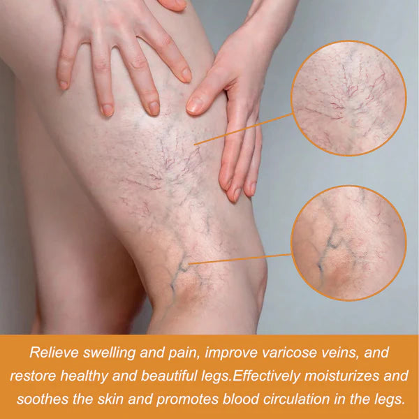 Turmeric Varicose Vein Relief Spray( BUY 1 GET 2 FREE💥 🎁 )