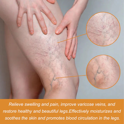 Turmeric Varicose Vein Relief Spray( BUY 1 GET 2 FREE💥 🎁 )